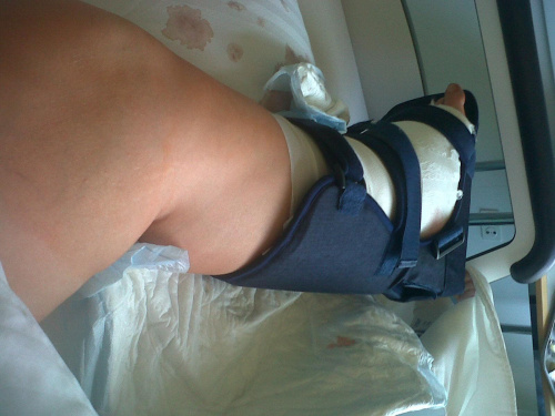 Po operacji-zabezpieczenie nogi #hintermann #ZłamanieKościSkokowej